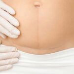 Terapia blizn po cięciu cesarskim i operacjach biustu