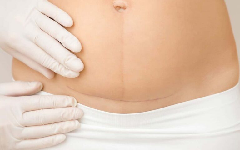 Terapia blizn po cięciu cesarskim i operacjach biustu